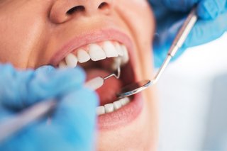Zahnarztbesuch: Frau mit geöffnetem Mund beim Zahnarzt der die Zähne kontrolliert