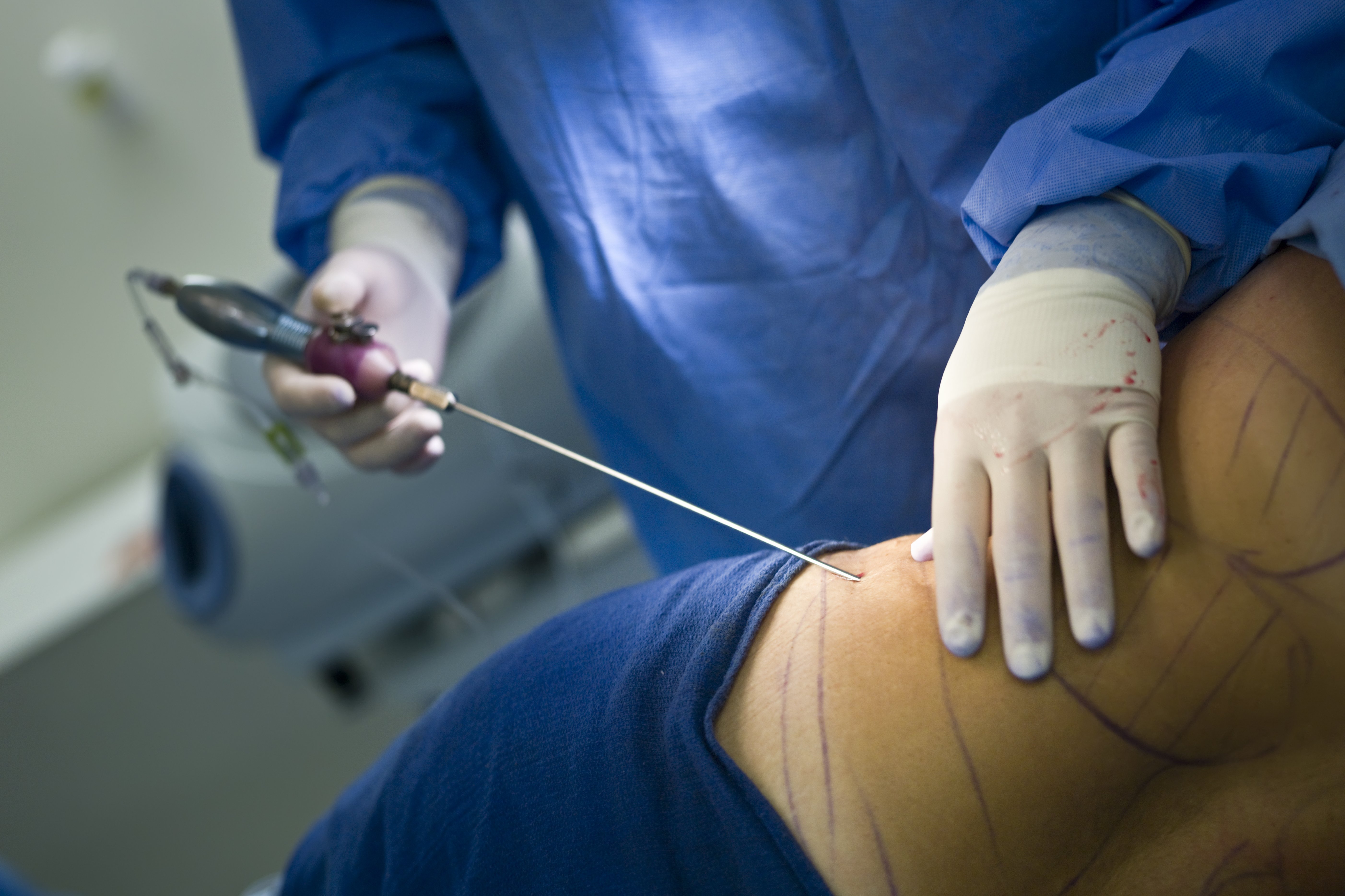 Arzt f&uuml;hrt eine Liposuktion durch