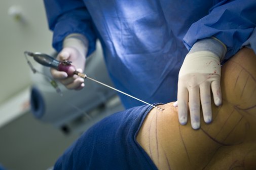 Liposuktion bei Lipödem Arzt führt eine Liposuktion durch