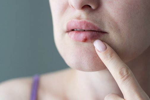 Lippenherpes Lippenbläschen Schmerzen Schutz Nahaufnahme eines weibliches Gesichts, auf der Lippe ist ein rotes Lippenbläschen zu sehen, ein Finger fährt in Richtung des Bläschens.